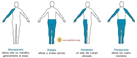 Foto de un niño con tetraparesia espástica