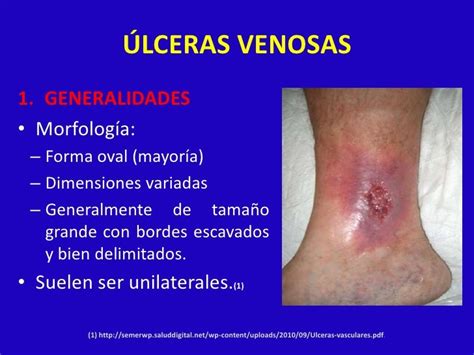 Foto de una úlcera venosa en la zona supramaleolar interna de la pierna