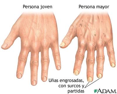 ilustraciones de los cambios en las uñas y la piel del pie de un adulto mayor