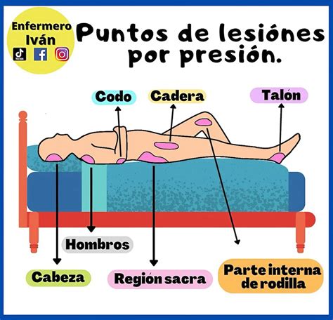 Gráfico: Causas y prevención de lesiones por presión en el paciente encamado