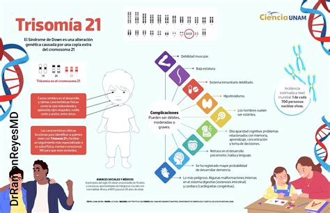 Infografía sobre la trisomía 21 y la causa genética del síndrome de Down