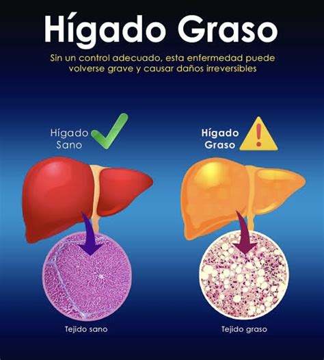 Infografía sobre la progresión de la enfermedad del hígado graso no alcohólico