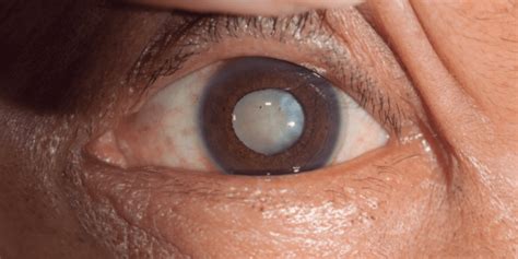 Fotografía de un ojo con catarata avanzada