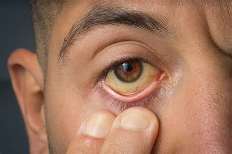 Hombre con ojos amarillos buscando atención médica