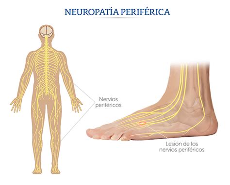 Infografía sobre las causas de la neuropatía periférica