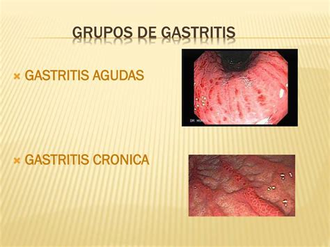 Esquema de los diferentes tipos de gastritis y su localización en el estómago