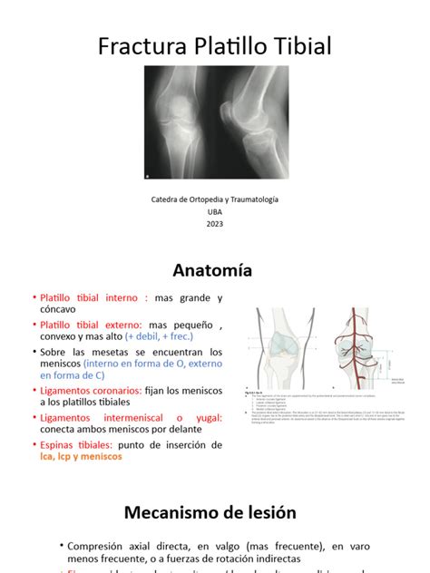 Esquema anatómico del platillo tibial y la rodilla con indicación de las áreas de fractura