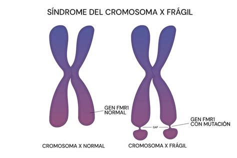 Infografía: Mecanismo del frágil X y FMR1