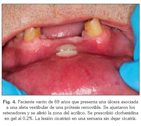 Ilustración de las lesiones más comunes en la mucosa oral del adulto mayor (úlceras, fibromas y estomatitis).