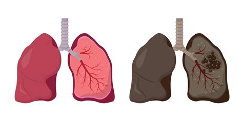 Diagrama de pulmones sanos vs. pulmones afectados por EPOC