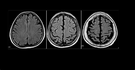 Imagen de resonancia magnética que muestra cambios cerebrales asociados al envejecimiento, como atrofia cortical