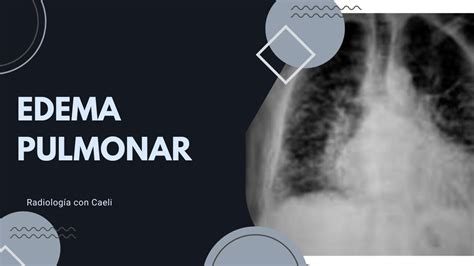 Ejemplo de radiografía con edema pulmonar