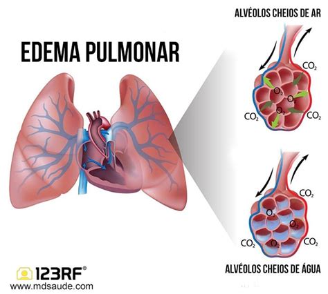 Gráfico de complicaciones asociadas al edema pulmonar en ancianos