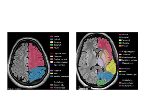 Diagrama de resonancia magnética cerebral con áreas afectadas