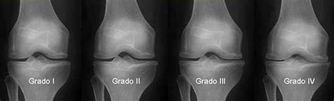 imágenes de radiografías de rodilla mostrando los diferentes grados de Kellgren-Lawrence