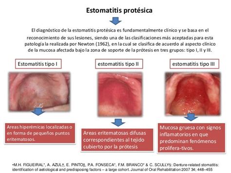 Imagen de estomatitis subprotésica en el paladar, mostrando enrojecimiento e irritación.