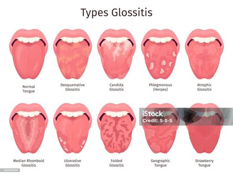 Imagen de una lengua con glositis o lengua geográfica, mostrando áreas lisas o con patrón similar a un mapa.