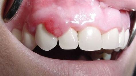 Fotografía de épulis fisuratum, mostrando una lesión de la mucosa oral en el borde de una prótesis dental.