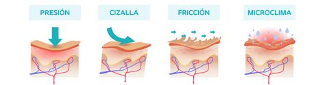 Esquema de la fisiopatología de las úlceras por presión, mostrando presión, cizallamiento, fricción, y humedad afectando la circulación y el tejido.