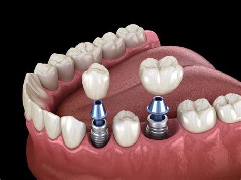 Foto de implantes dentales en una boca