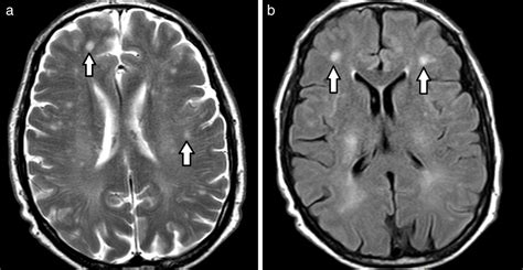 Resonancia magnética de cerebro mostrando lesiones de sustancia blanca