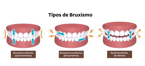Esquema de la mandíbula y dientes mostrando el movimiento de rechinamiento del bruxismo