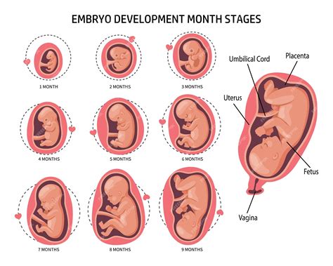 Ilustración de cómo una infección puede afectar el desarrollo fetal