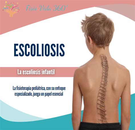 Infografía: Factores para considerar la escoliosis como discapacidad
