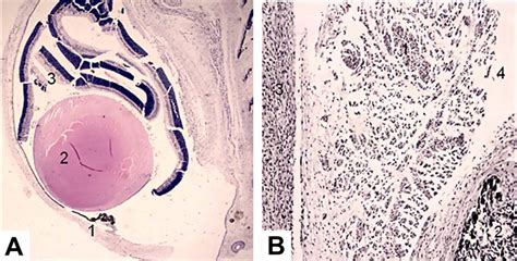 Microfotografía de corte histológico mostrando calcificaciones intraconducto y obliteración parcial del sistema radicular debido a atrición severa.