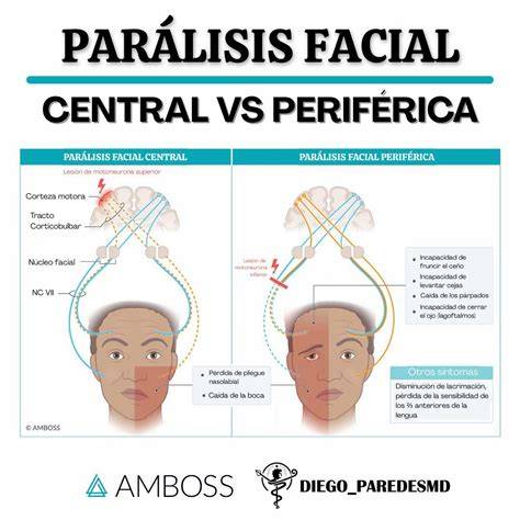 Infografía: Diferencias entre parálisis facial periférica y central