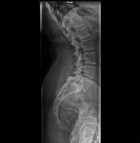 Radiografía de columna vertebral mostrando fractura y lesiones metastásicas en las vértebras