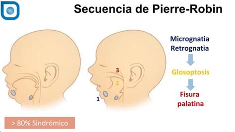 Gráfica de secuencia de Pierre Robin: mandíbula pequeña, glosoptosis y fisura palatina