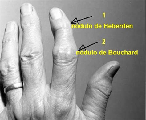 Foto de una mano con nódulos de Heberden visibles en las articulaciones de los dedos