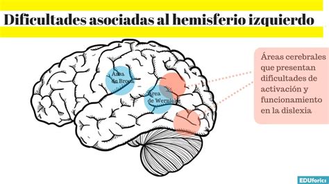 Esquema de las interconexiones cerebrales afectadas por trastornos neurológicos