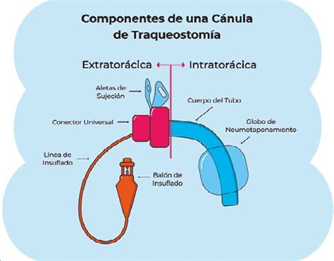 Esquema anatómico de la traqueostomía y la inserción de la cánula traqueal