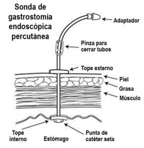 Esquema anatómico mostrando la colocación de una sonda de gastrostomía percutánea en el estómago.