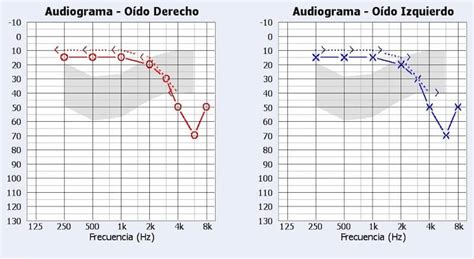Gráfico de audiometría mostrando umbrales auditivos para diferentes frecuencias
