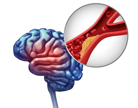 Esquema de las causas y efectos de un accidente cerebrovascular