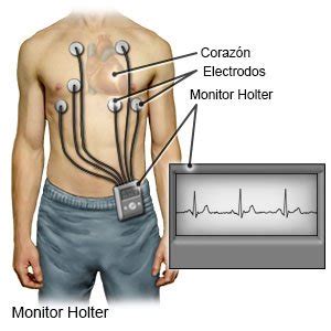 Imagen de un monitor Holter con sus electrodos en el pecho de un paciente
