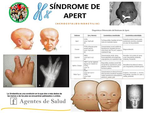 Esquema de las malformaciones asociadas al Síndrome de Apert