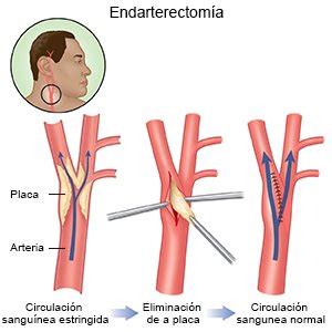 Diagrama de una endarterectomía carotídea