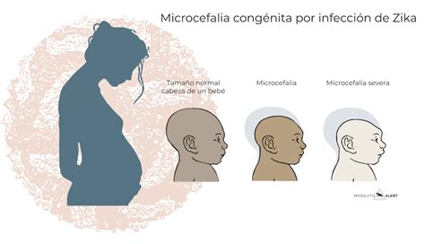 Infografía sobre las causas de la microcefalia durante el embarazo