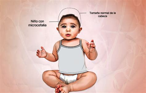 Ilustración de un niño con signos de microcefalia y retraso en el desarrollo