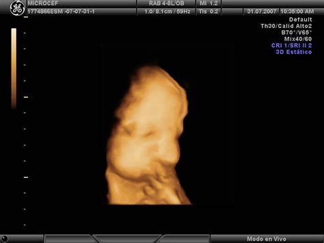 Imagen de ultrasonido mostrando una cabeza fetal con microcefalia