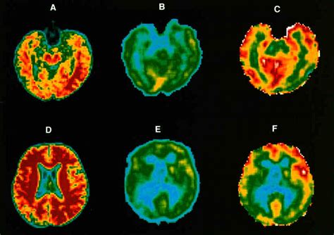 Tomografía por Emisión de Positrones (TEP) revelando áreas de alta actividad metabólica en el cerebro.