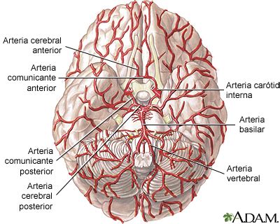 Esquema de las arterias del cerebro mostrando una obstrucción
