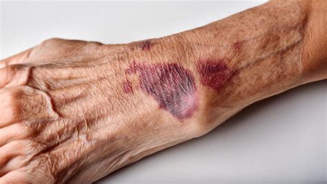 Foto de piel de persona mayor con varios hematomas