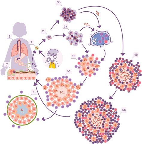 esquema de la patogénesis de la tuberculosis pulmonar