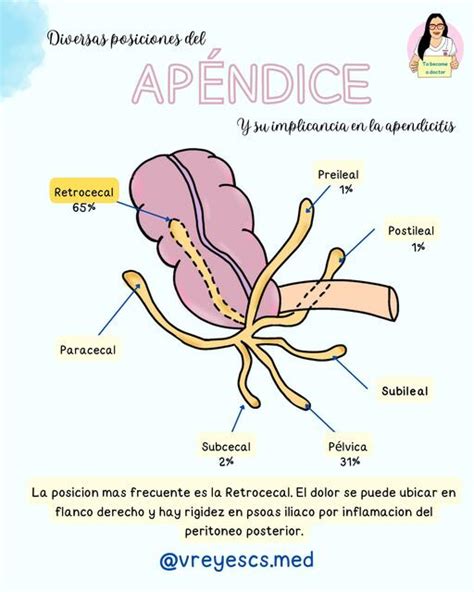 Esquema anatómico del abdomen resaltando el apéndice cecal inflamado