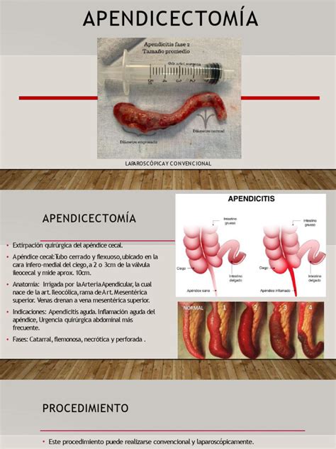 Comparativa visual de las incisiones en una apendicectomía laparoscópica y una apendicectomía abierta